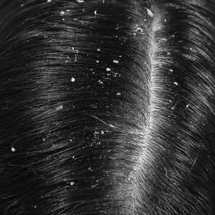 Dandruff & Hair Fall Control